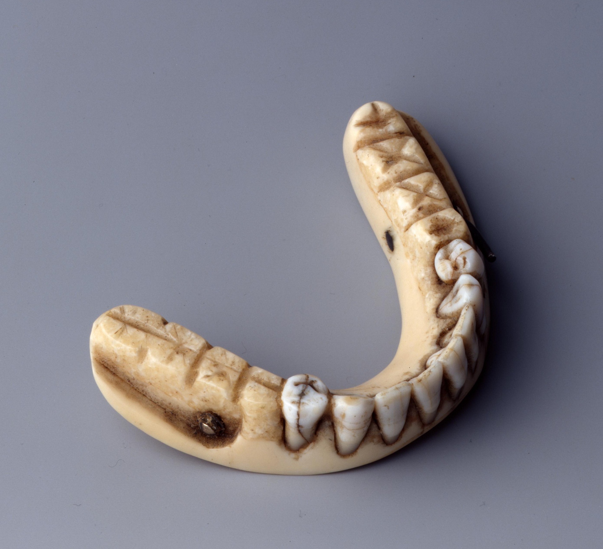 Untere Vollprothese, so genannte Waterloo-Zähne
